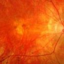 Новый тест на глаукому позволяет начать лечение до появления первых симптомов потери зрения