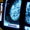 Новый тест поможет пациенткам с раком молочной железы избежать химиотерапии