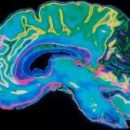 ИИ от IBM может предсказать шизофрению, просто изучив кровоток в мозге