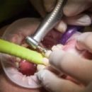 Учёные обнаружили лекарственный препарат, который залечивает кариозные полости и регенерирует зубы