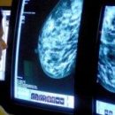 Похудение может снизить риск развития рака молочной железы