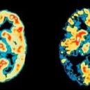 Впервые удалось нейтрализовать ген Альцгеймера в клетках человеческого мозга