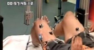 Человек с травмированным позвоночником и параличом ног сможет стоять и двигаться