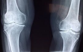 Новый имплантат исцеляет сломанные ноги, превращаясь в настоящую кость Новый имплантат исцеляет сломанные ноги, превращаясь в настоящую кость