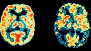 Электрическая стимуляция определённых долей мозга повышает память на 15 процентов